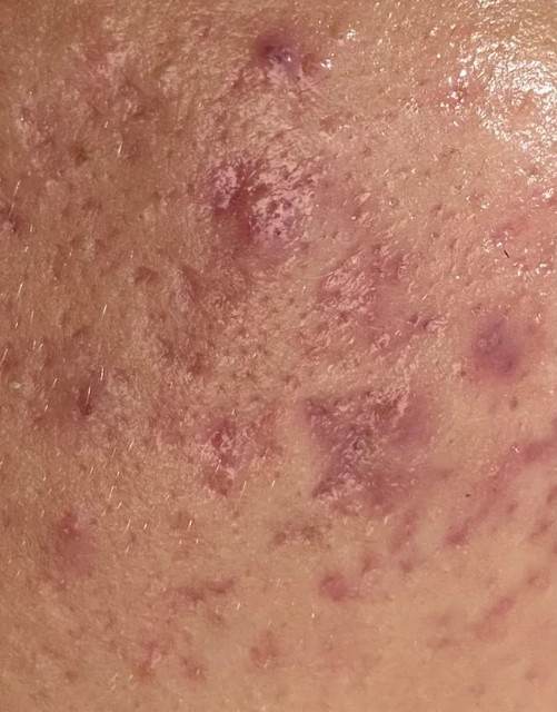 Plano de Tratamento Acne + Cicatriz: antes