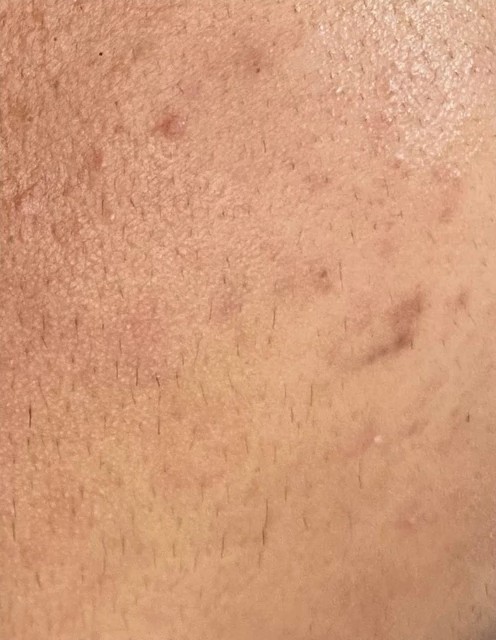 Plano de Tratamento Acne + Cicatriz: depois