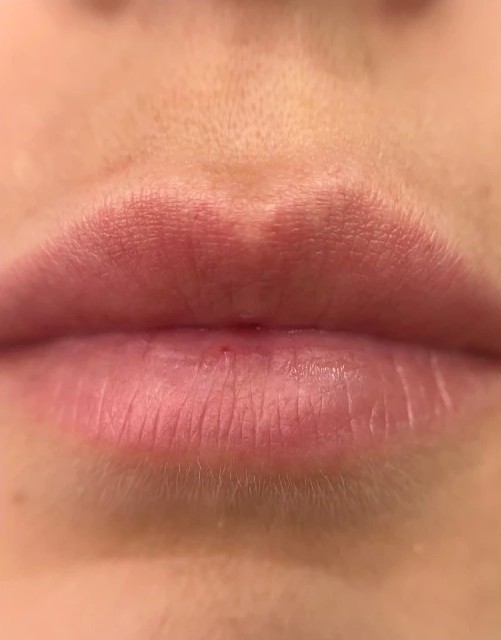 Balm Lips UP: antes