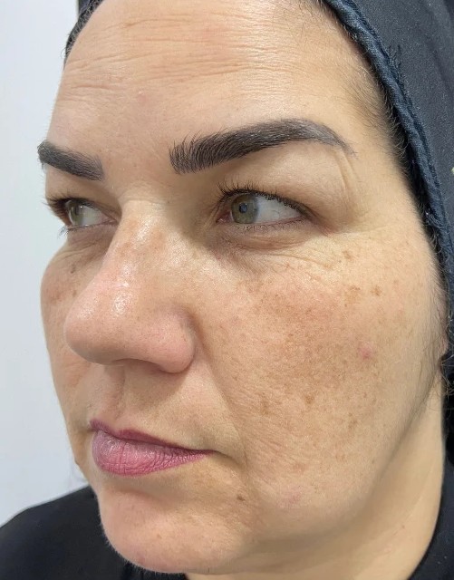 Plano Facial Pele de Porcelana: antes