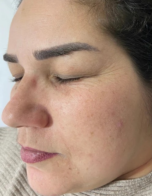 Plano Facial Pele de Porcelana: depois