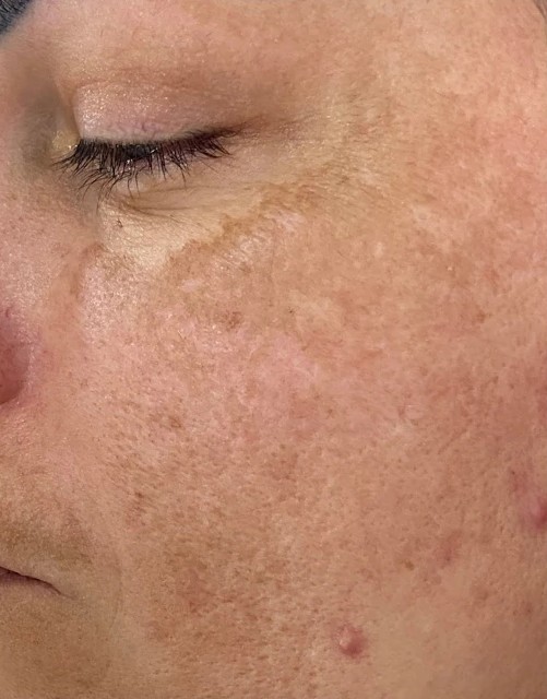 Plano Facial Pele de Porcelana: antes