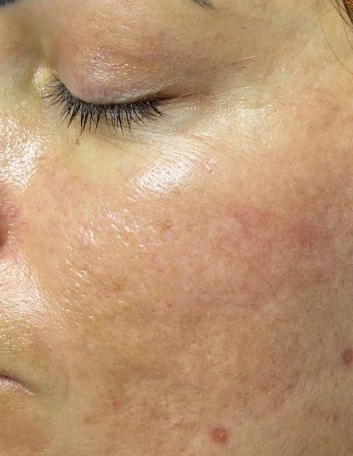 Plano Facial Pele de Porcelana: depois